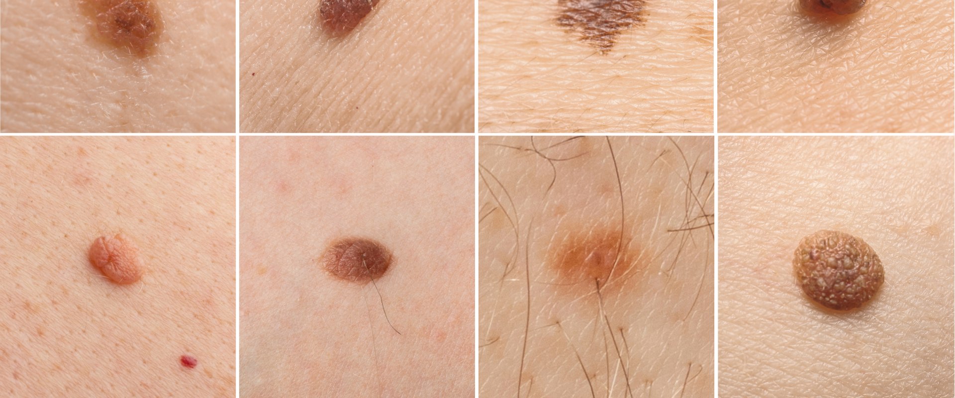 Understanding Melanoma: What You Need to Know