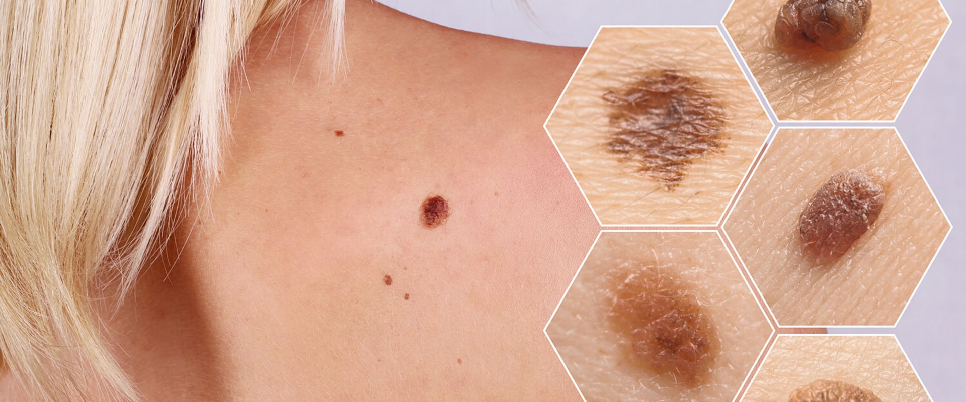 what-you-need-to-know-about-melanoma-skin-cancer