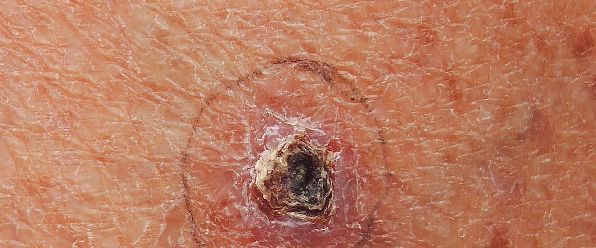 Understanding Skin Cancer Prognosis: What You Need to Know